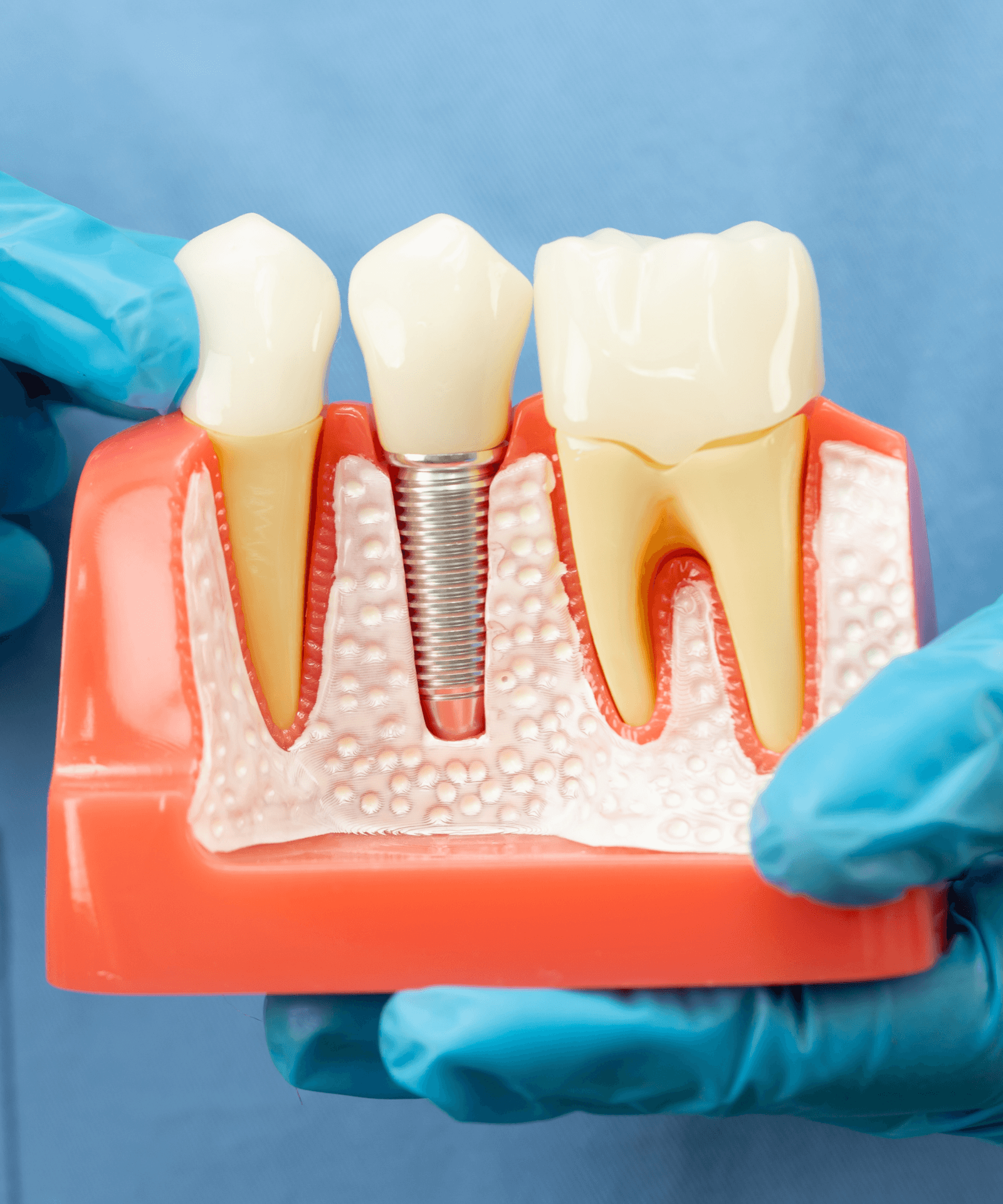 Dental Implants