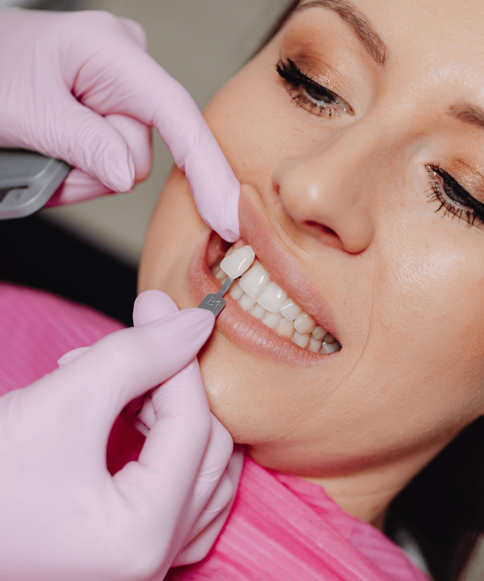Veneers