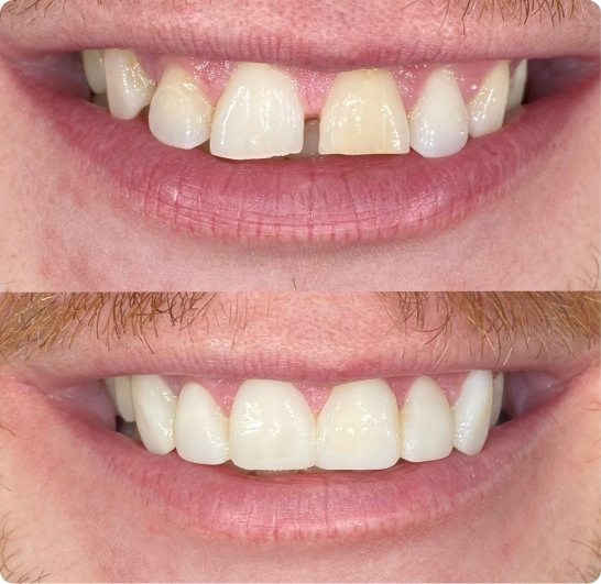 After and before composite bonding treatment in Mold