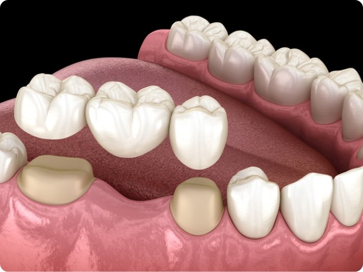 Fixed dental bridges in Mold
