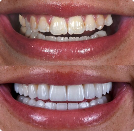 Before and after dental bridge treatment in Mold