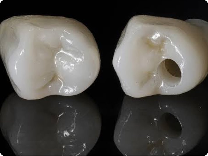 Custom-made dental crown restoring a damaged tooth