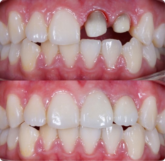 After and before Dental crown treatment at Alyn Dental, Mold
