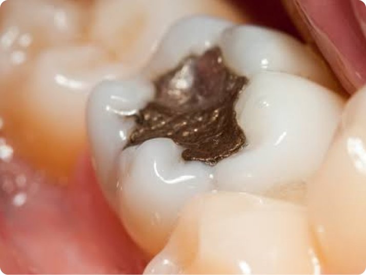 Dental filling treatment for damaged teeth in Mold