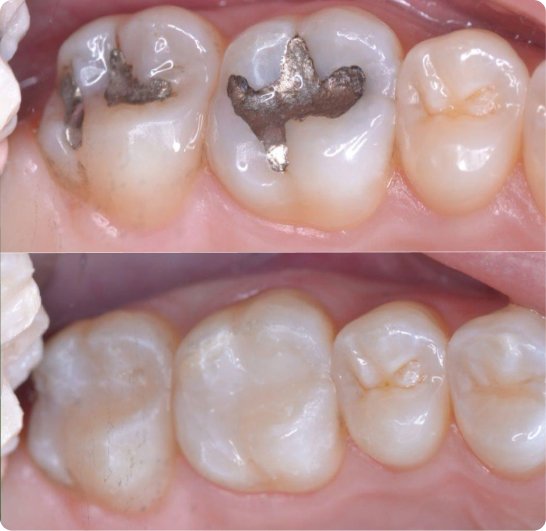 Before and after dental filling treatment in Mold