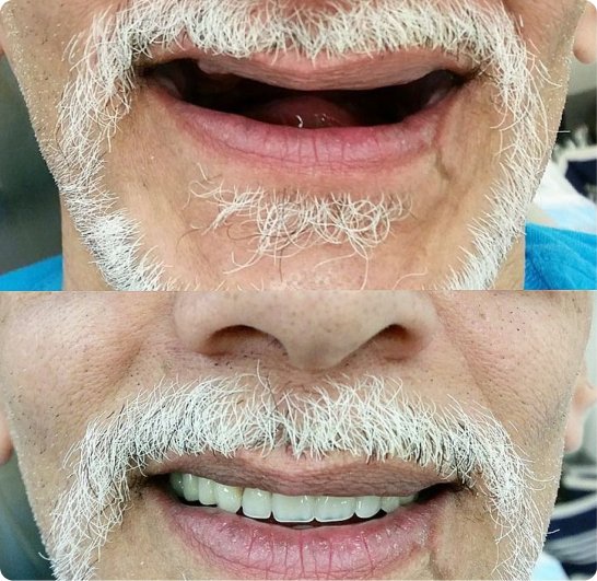 Dentures before and after treatment in Mold