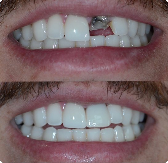 Before and after emergency dental treatment in Mold