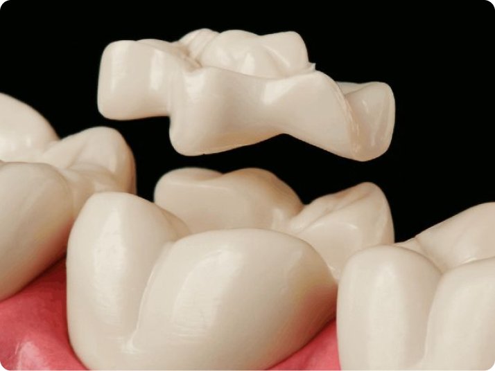 Tooth restoration with inlays and onlays in Mold