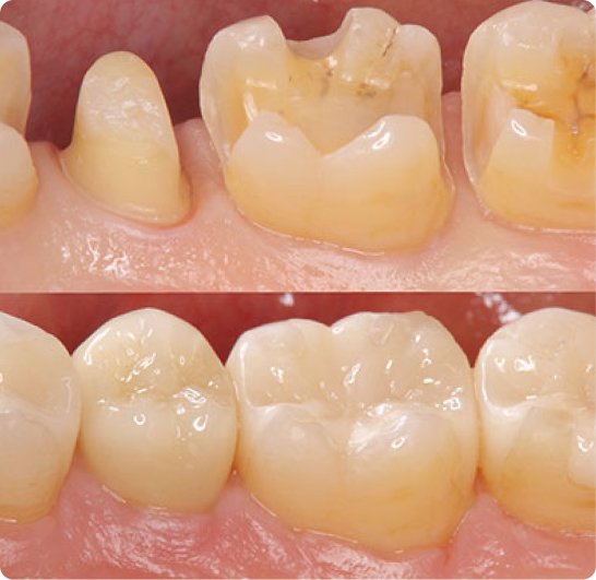 Inlays and onlays before and after treatment in Mold