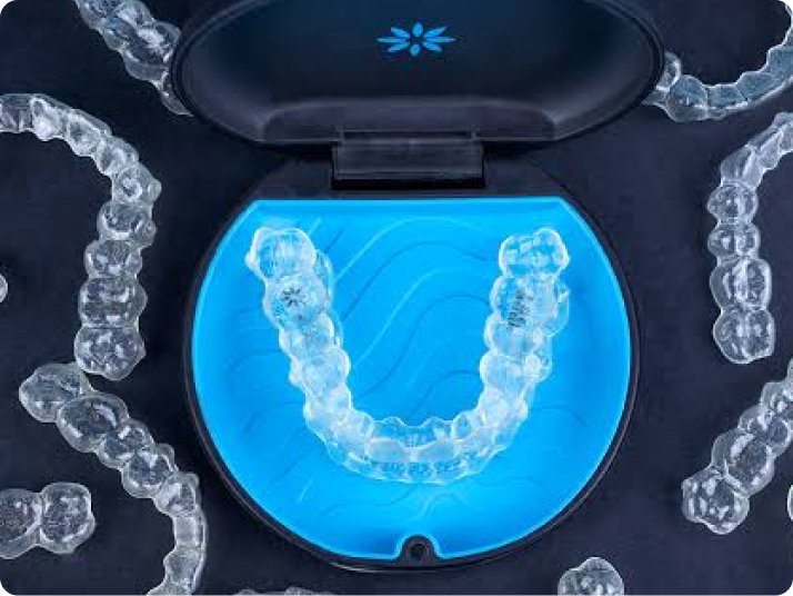 Clear aligners treatment in Mold
