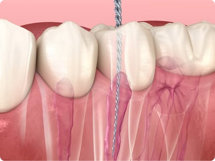 Root canal treatment for infected teeth in Mold