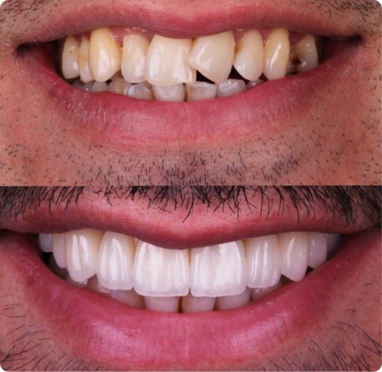 Before and after root canal treatment in Mold
