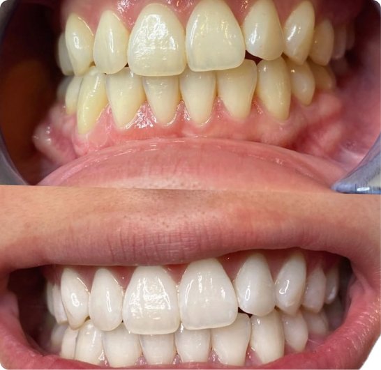 Before and after teeth whitening treatment in Mold