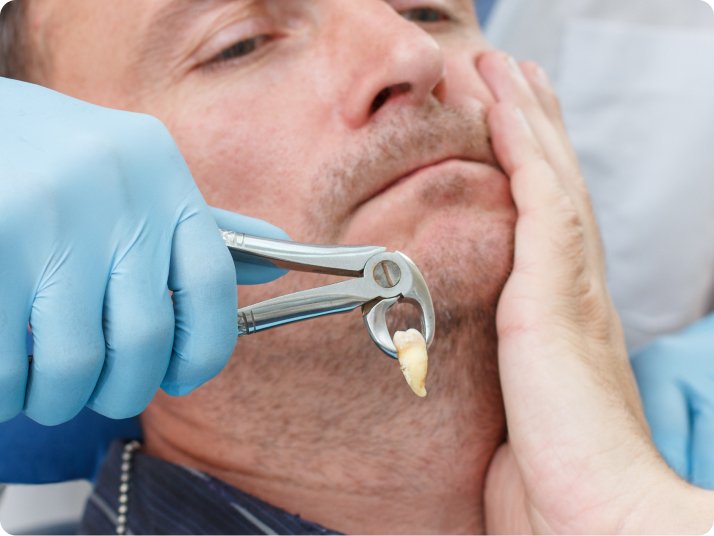 Dental extraction for damaged teeth in Mold