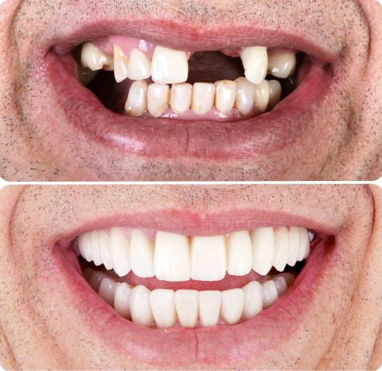 Tooth extraction before and after treatment in Mold