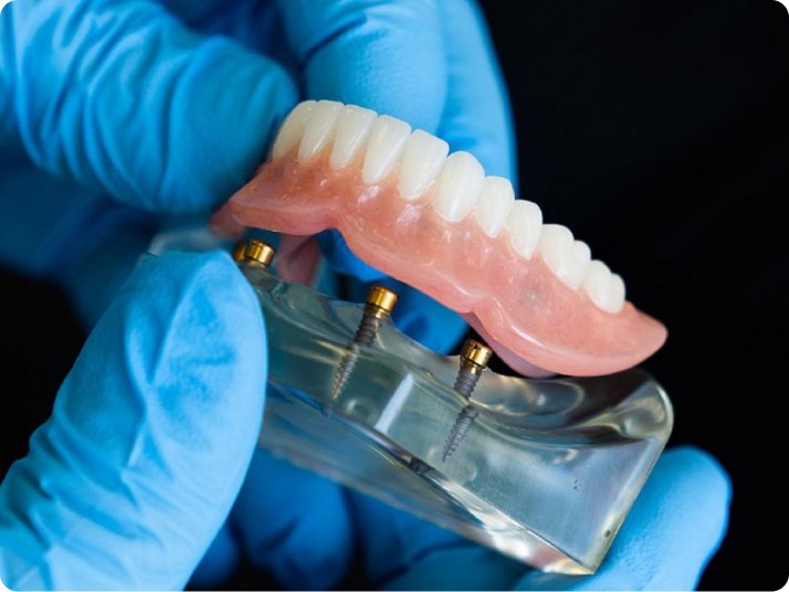 Dental implant replacing a missing tooth